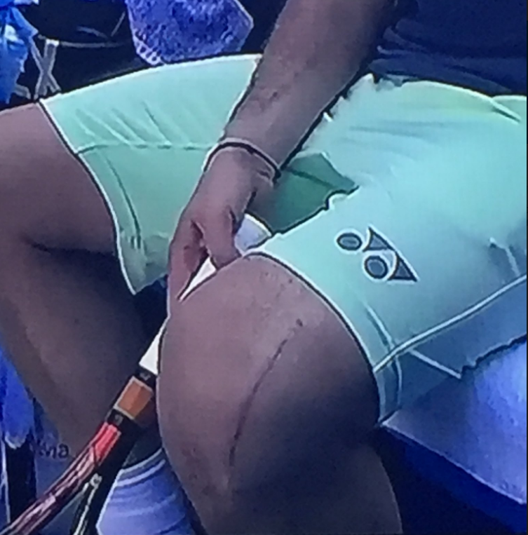 L'impressionnante cicatrice de Wawrinka, opéré du genou en août dernier et enfin de retour à Melbourne